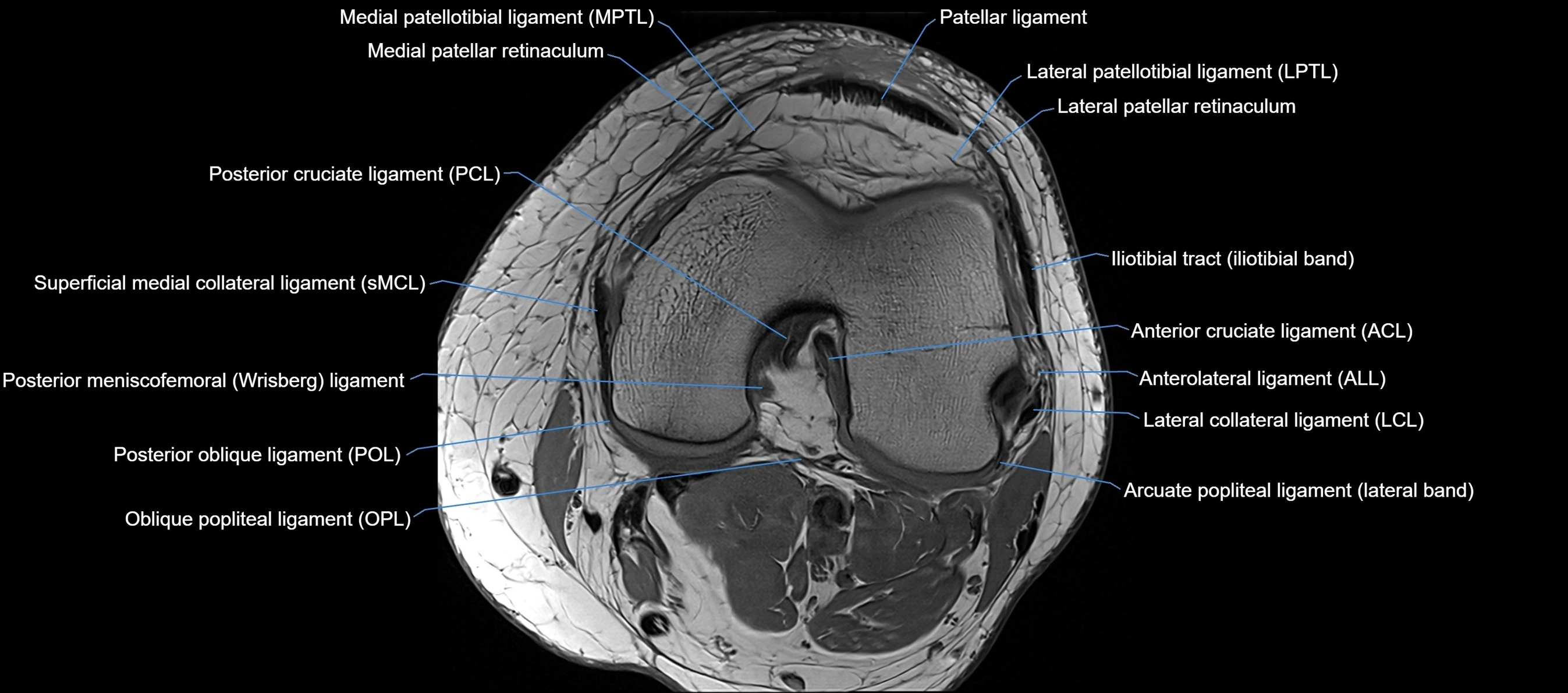 MRI Knee axial  ligaments cross sectional anatomy 3T  radiology  image-img-03001-00024.webp